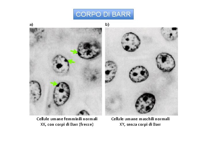 CORPO DI BARR Cellule umane femminili normali XX, con corpi di Barr (frecce) Cellule
