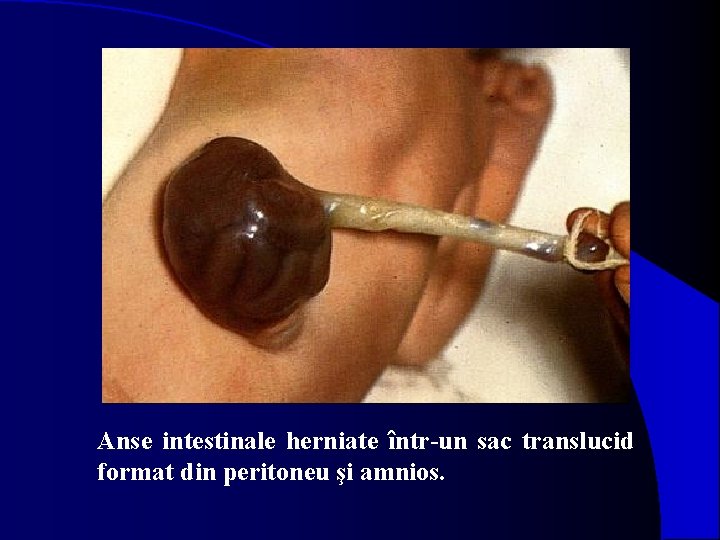 Anse intestinale herniate într-un sac translucid format din peritoneu şi amnios. 