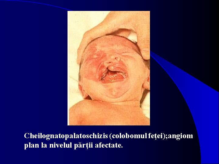 Cheilognatopalatoschizis (colobomul feţei); angiom plan la nivelul părţii afectate. 