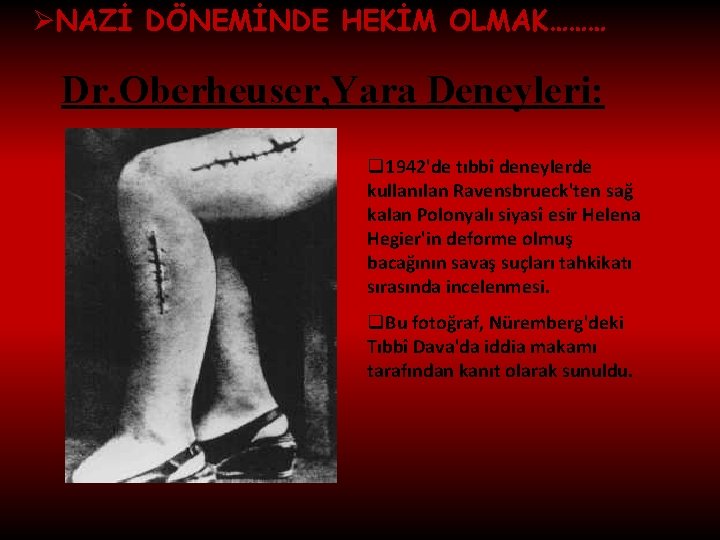 ØNAZİ DÖNEMİNDE HEKİM OLMAK……… Dr. Oberheuser, Yara Deneyleri: q 1942'de tıbbî deneylerde kullanılan Ravensbrueck'ten