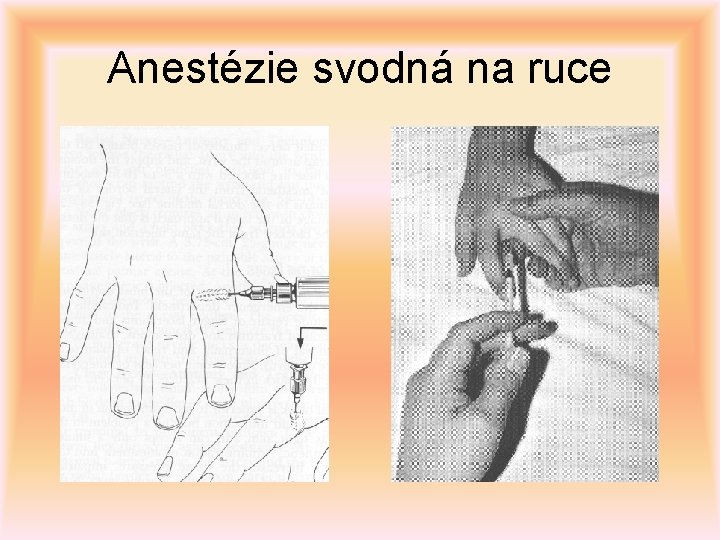 Anestézie svodná na ruce 