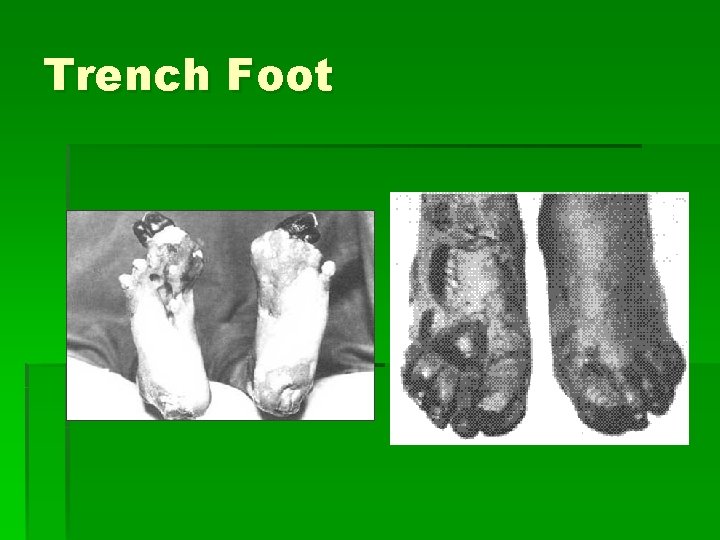 Trench Foot 