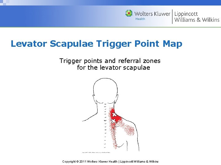 Levator Scapulae Trigger Point Map Trigger points and referral zones for the levator scapulae