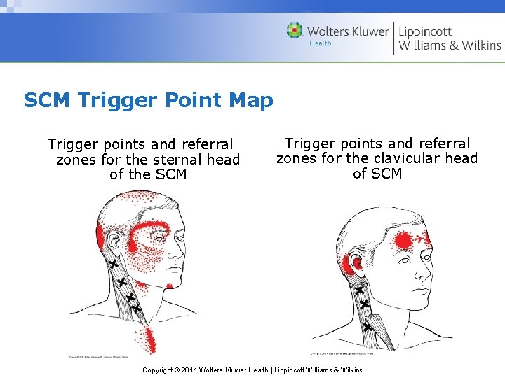SCM Trigger Point Map Trigger points and referral zones for the sternal head of