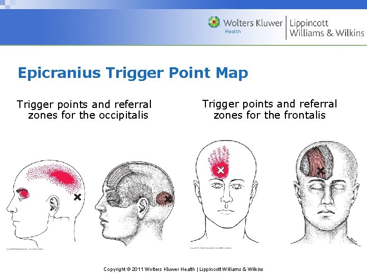 Epicranius Trigger Point Map Trigger points and referral zones for the occipitalis Trigger points