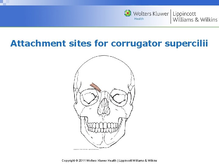 Attachment sites for corrugator supercilii Copyright © 2011 Wolters Kluwer Health | Lippincott Williams