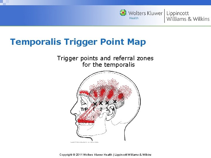 Temporalis Trigger Point Map Trigger points and referral zones for the temporalis Copyright ©