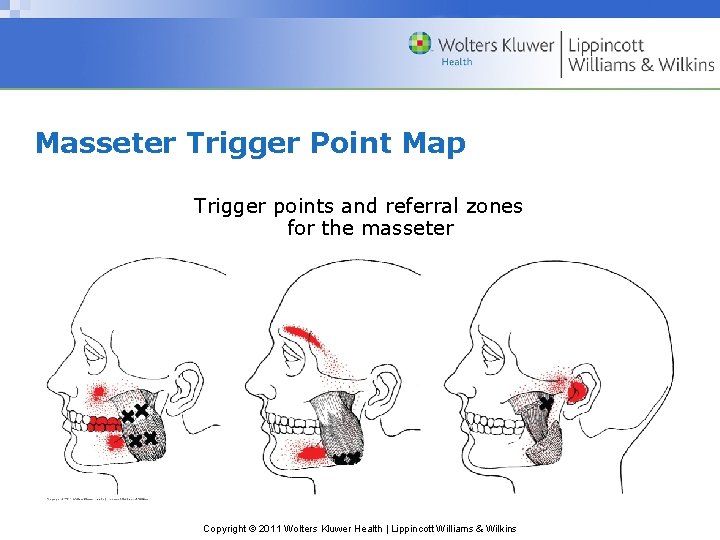 Masseter Trigger Point Map Trigger points and referral zones for the masseter Copyright ©