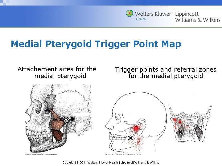 Medial Pterygoid Trigger Point Map Attachement sites for the medial pterygoid Trigger points and