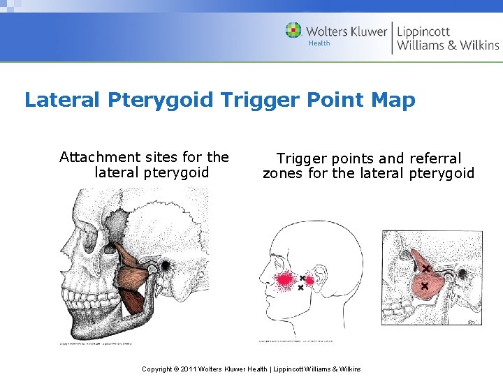 Lateral Pterygoid Trigger Point Map Attachment sites for the lateral pterygoid Trigger points and