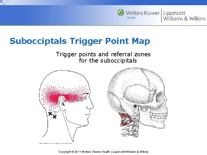 Subocciptals Trigger Point Map Trigger points and referral zones for the suboccipitals Copyright ©