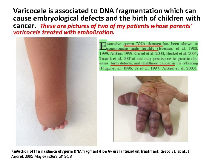 Varicocele is associated to DNA fragmentation which can cause embryological defects and the birth