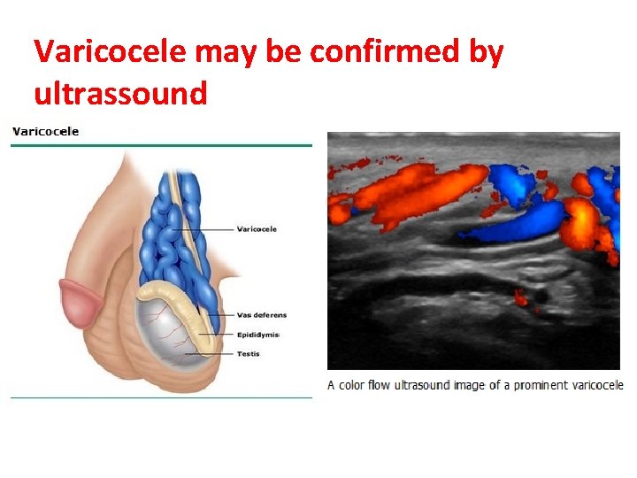 Varicocele may be confirmed by ultrassound 