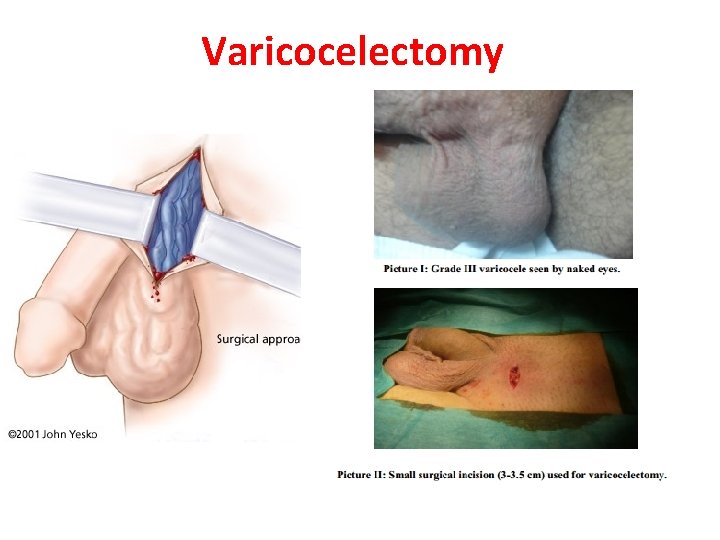 Varicocelectomy 