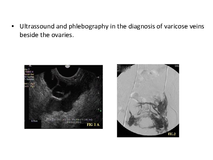  • Ultrassound and phlebography in the diagnosis of varicose veins beside the ovaries.