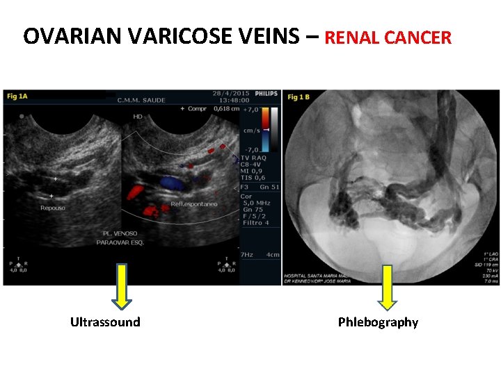 OVARIAN VARICOSE VEINS – RENAL CANCER Ultrassound Phlebography 