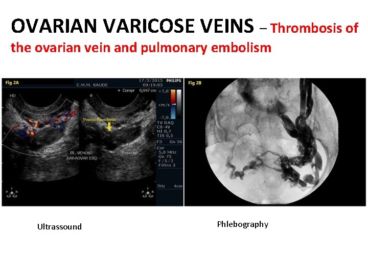OVARIAN VARICOSE VEINS – Thrombosis of the ovarian vein and pulmonary embolism Ultrassound Phlebography