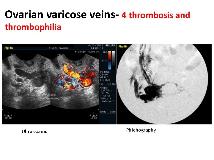 Ovarian varicose veins- 4 thrombosis and thrombophilia Ultrassound Phlebography 