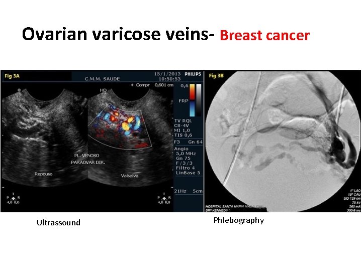 Ovarian varicose veins- Breast cancer Ultrassound Phlebography 