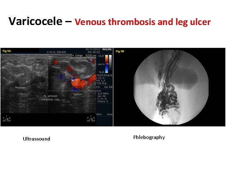 Varicocele – Venous thrombosis and leg ulcer Ultrassound Phlebography 