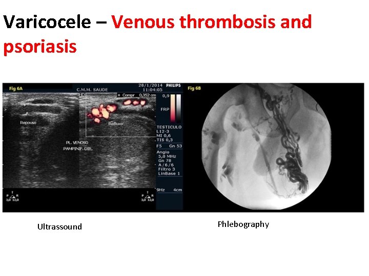 Varicocele – Venous thrombosis and psoriasis Ultrassound Phlebography 