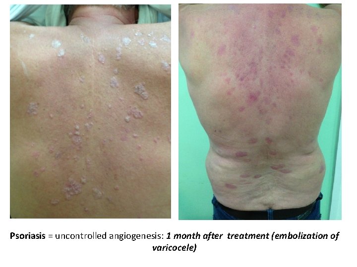 Psoriasis = uncontrolled angiogenesis: 1 month after treatment (embolization of varicocele) 