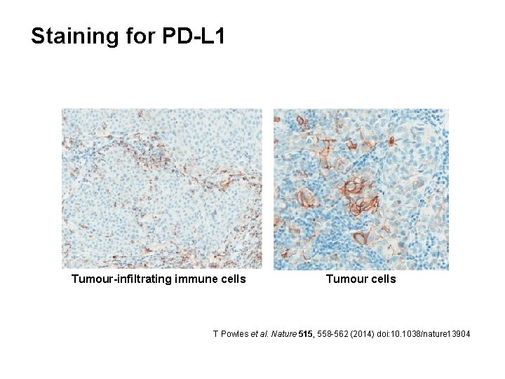 Staining for PD-L 1 Tumour-infiltrating immune cells Tumour cells T Powles et al. Nature