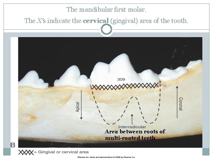 The mandibular first molar. The X’s indicate the cervical (gingival) area of the tooth.