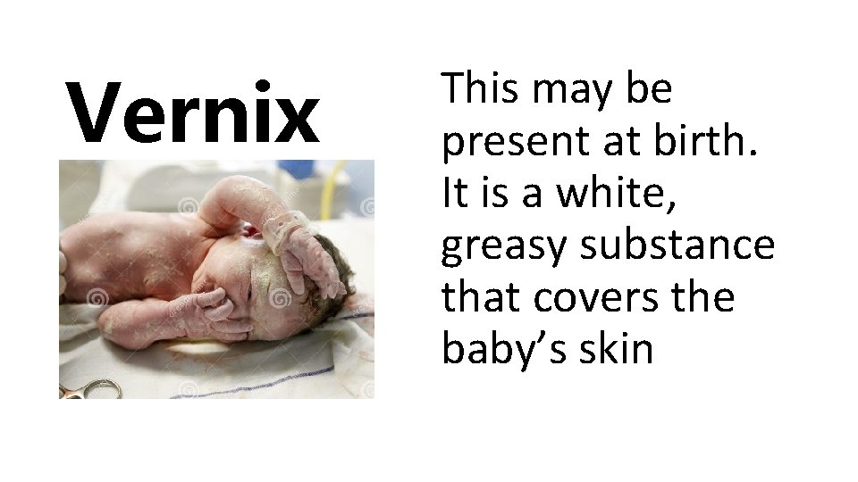 Vernix This may be present at birth. It is a white, greasy substance that