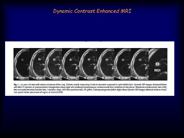 Dynamic Contrast Enhanced MRI 