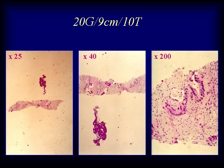 20 G/9 cm/10 T x 25 x 40 x 200 5 mm Adenocarcinoma H&E