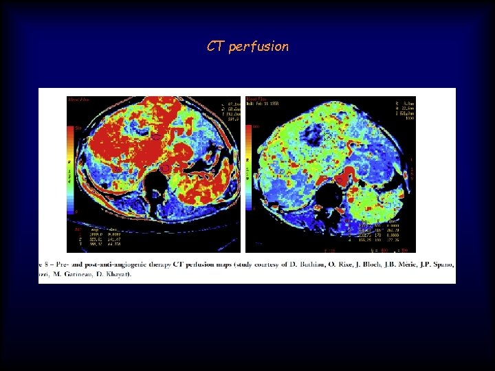 CT perfusion 