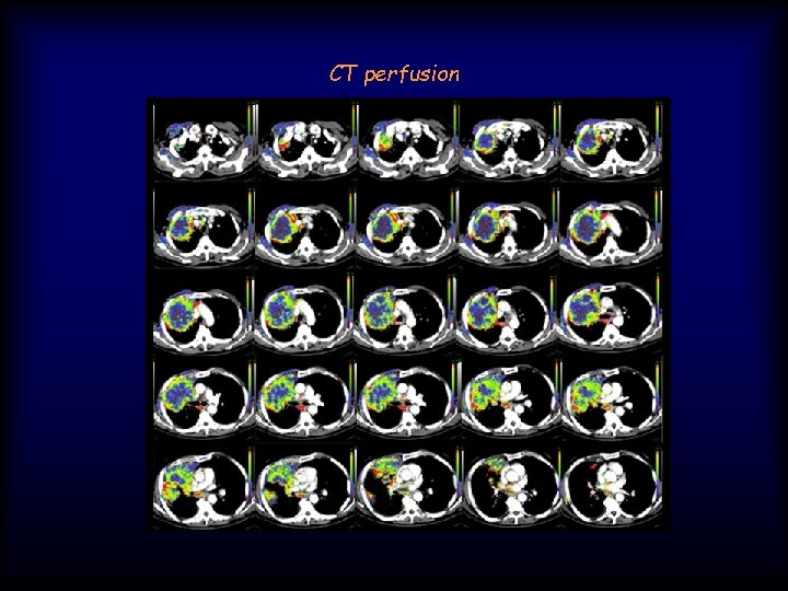 CT perfusion 