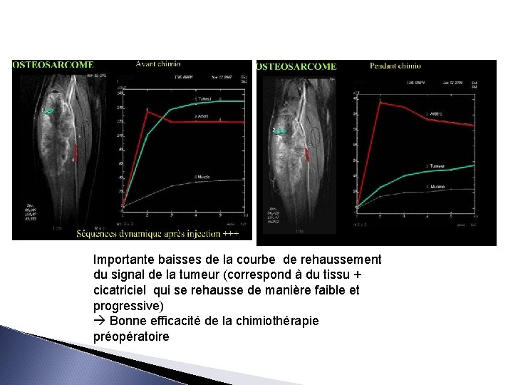 Importante baisses de la courbe de rehaussement du signal de la tumeur (correspond à