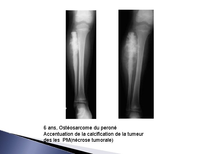 6 ans, Ostéosarcome du peroné Accentuation de la calcification de la tumeur des les