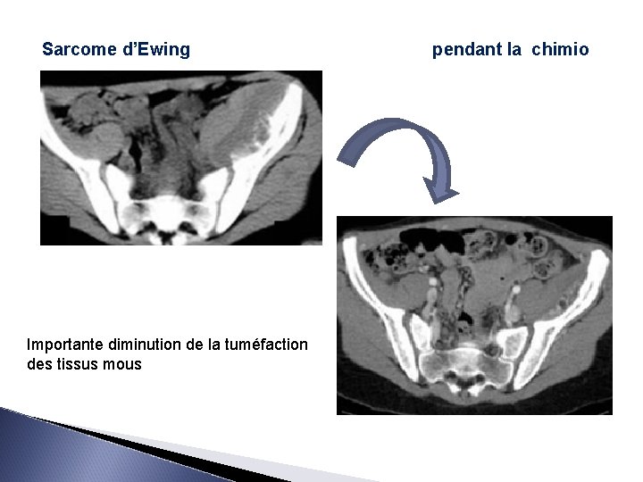 Sarcome d’Ewing Importante diminution de la tuméfaction des tissus mous pendant la chimio 