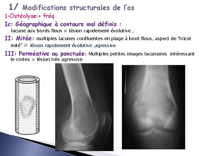 1/ Modifications structurales de l’os 1 -Ostéolyse: + fréq Ic: Géographique à contours mal