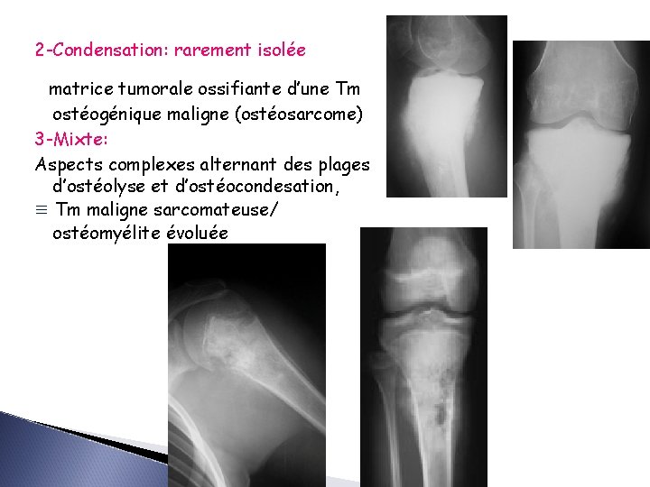 2 -Condensation: rarement isolée matrice tumorale ossifiante d’une Tm ostéogénique maligne (ostéosarcome) 3 -Mixte: