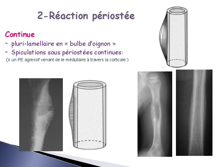 2 -Réaction périostée Continue pluri-lamellaire en « bulbe d’oignon » Spiculations sous périostées continues: