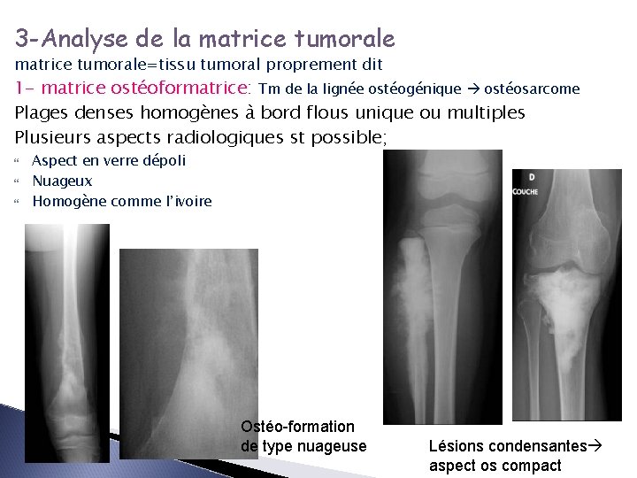 3 -Analyse de la matrice tumorale=tissu tumoral proprement dit 1 - matrice ostéoformatrice: ostéoformatrice