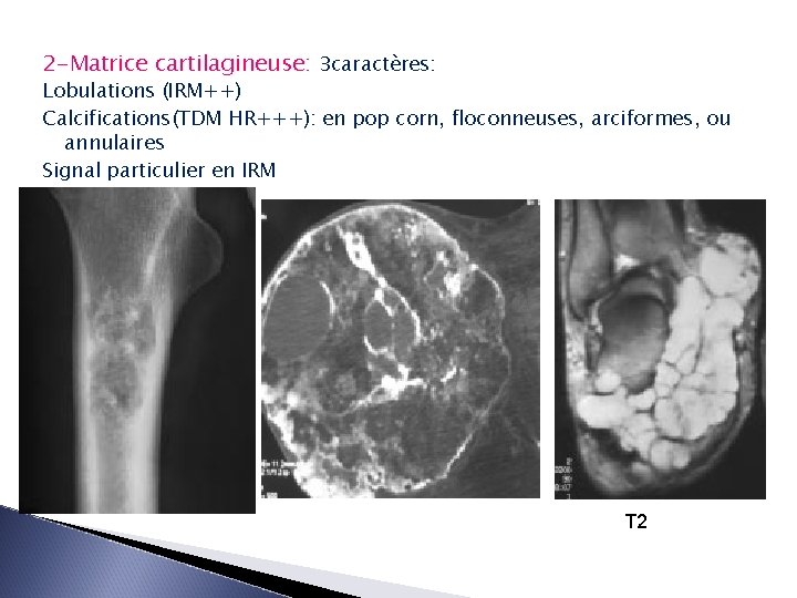 2 -Matrice cartilagineuse: 3 caractères: Lobulations (IRM++) Calcifications(TDM HR+++): en pop corn, floconneuses, arciformes,