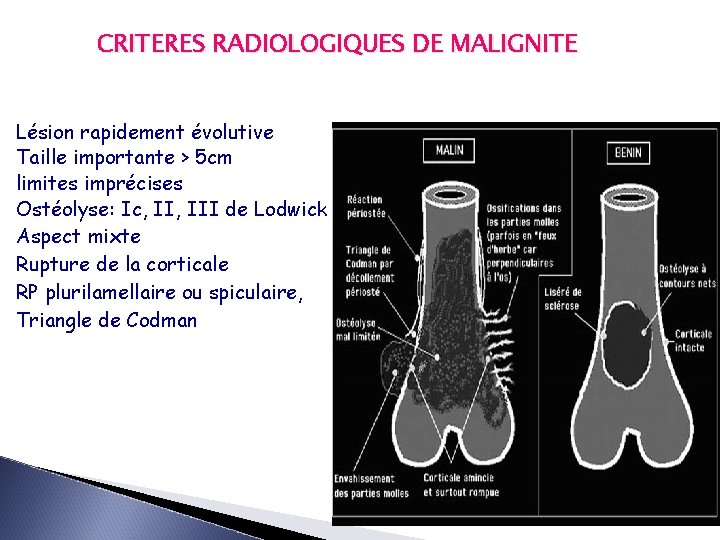 CRITERES RADIOLOGIQUES DE MALIGNITE Lésion rapidement évolutive Taille importante > 5 cm limites imprécises