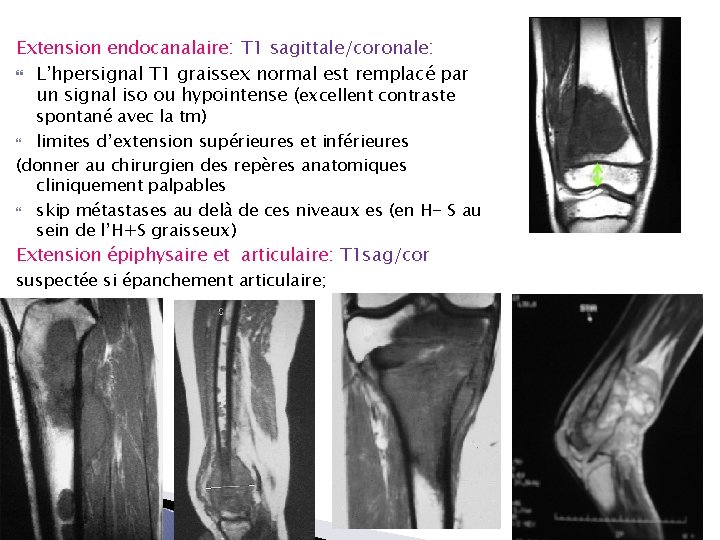 Extension endocanalaire: T 1 sagittale/coronale: L’hpersignal T 1 graissex normal est remplacé par un