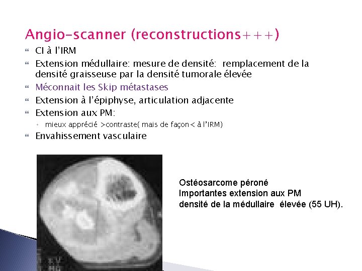 Angio-scanner (reconstructions+++) CI à l’IRM Extension médullaire: mesure de densité: remplacement de la densité