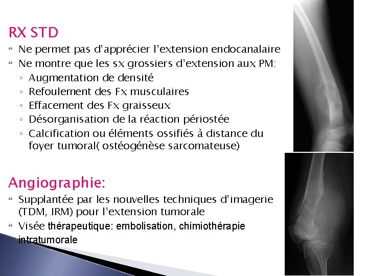 RX STD Ne permet pas d’apprécier l’extension endocanalaire Ne montre que les sx grossiers