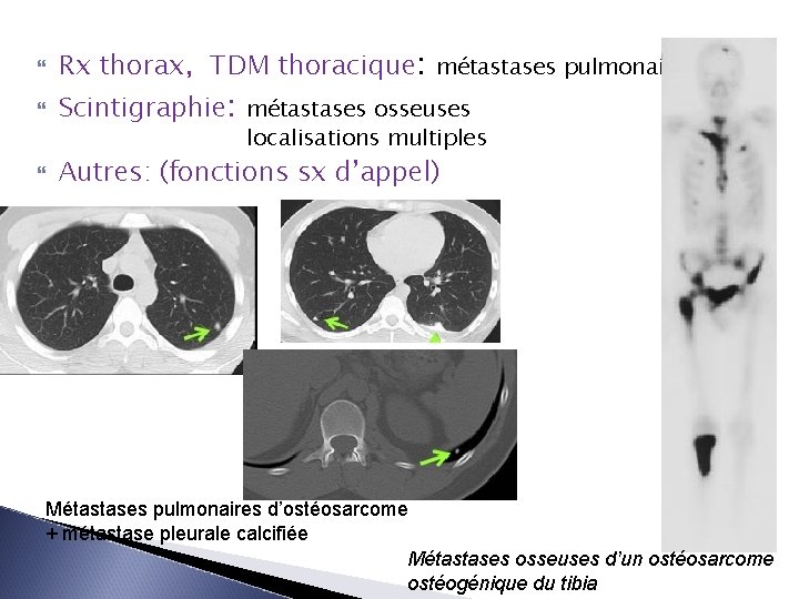  Rx thorax, TDM thoracique: métastases pulmonaires Scintigraphie: métastases osseuses localisations multiples Autres: (fonctions