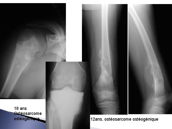 18 ans Ostéosarcome ostéogénique 12 ans, ostéosarcome ostéogénique 