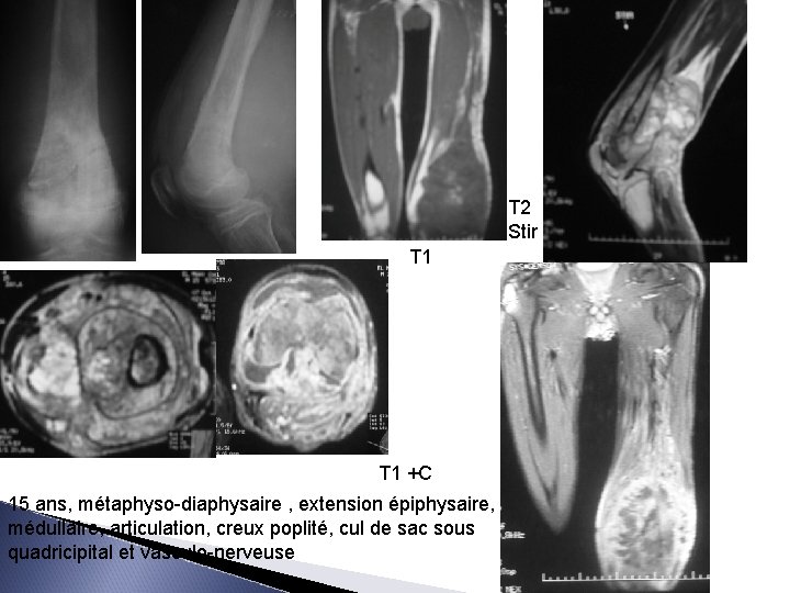 T 2 Stir T 1 +C 15 ans, métaphyso-diaphysaire , extension épiphysaire, médullaire, articulation,