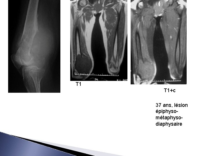 T 1 T 1+c 37 ans, lésion épiphysométaphysodiaphysaire 