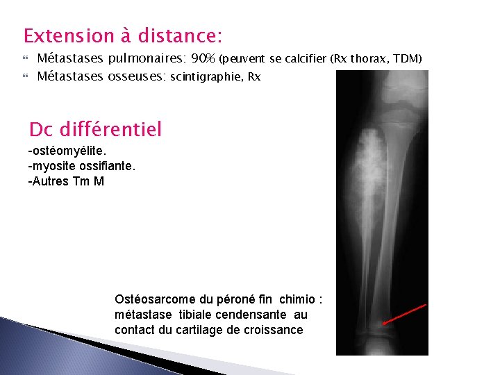 Extension à distance: Métastases pulmonaires: 90% (peuvent se calcifier (Rx thorax, TDM) Métastases osseuses: